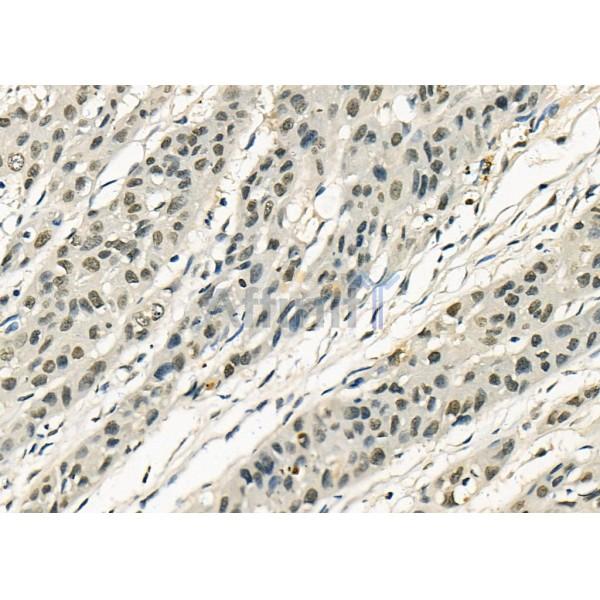MYBPC3 Antibody - DF8063 at 1/100 staining Human esophageal cancer by IHC-P.