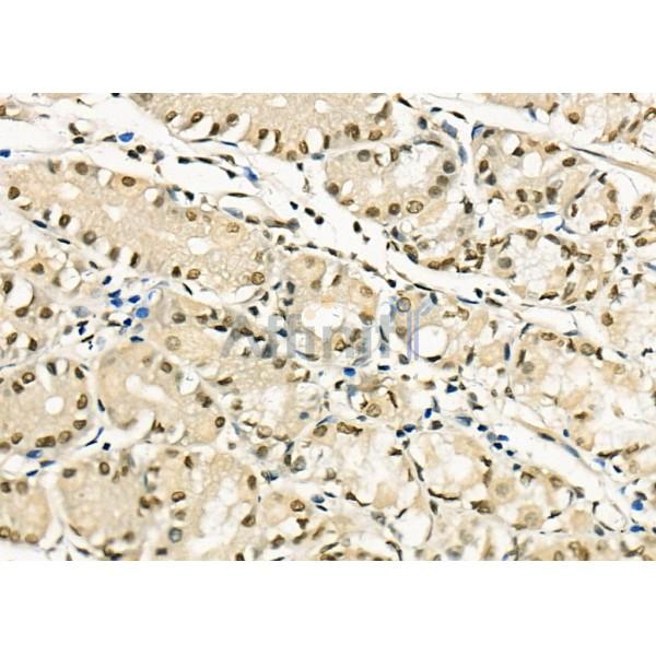 MYBPC3 Antibody - DF8063 at 1/100 staining Human colorectal cancer and para-carcinoma tissue by IHC-P.