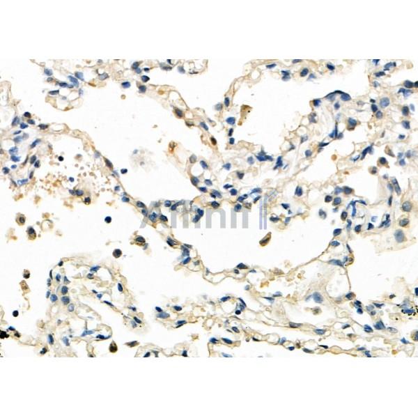 MLLT11 Antibody - DF8213 at 1/100 staining Human lung cancer and para-carcinoma tissue by IHC-P.