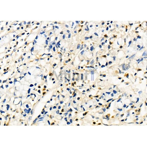 COPS7B Antibody - DF8376 at 1/100 staining Human colorectal cancer by IHC-P.