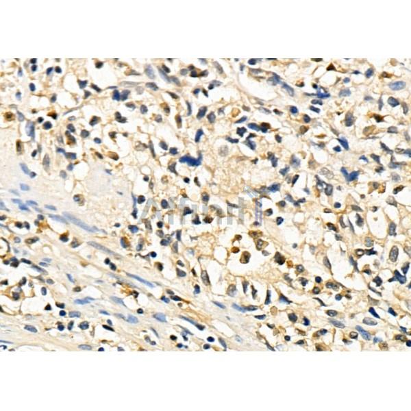CHD1L Antibody - DF8521 at 1/100 staining Human colorectal cancer by IHC-P.