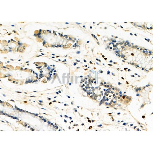 FAKD2 Antibody - DF8656 at 1/100 staining Human pancreatic cancer and para-carcinoma tissue by IHC-P.