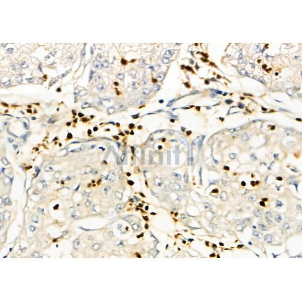 FAKD2 Antibody - DF8656 at 1/100 staining Human pancreatic cancer by IHC-P.