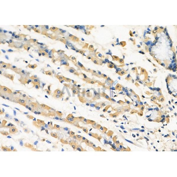 RIOK3 Antibody - DF8715 at 1/100 staining Human gastric cancer and para-carcinoma tissue by IHC-P.