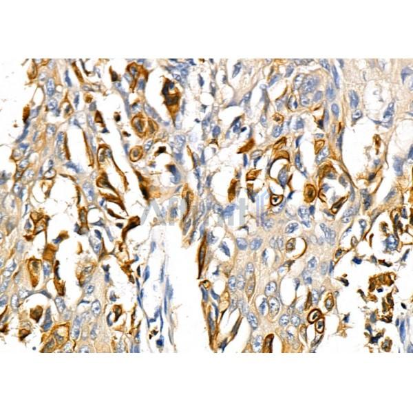 RNF19A Antibody - DF8717 at 1/100 staining Human esophageal cancer by IHC-P.