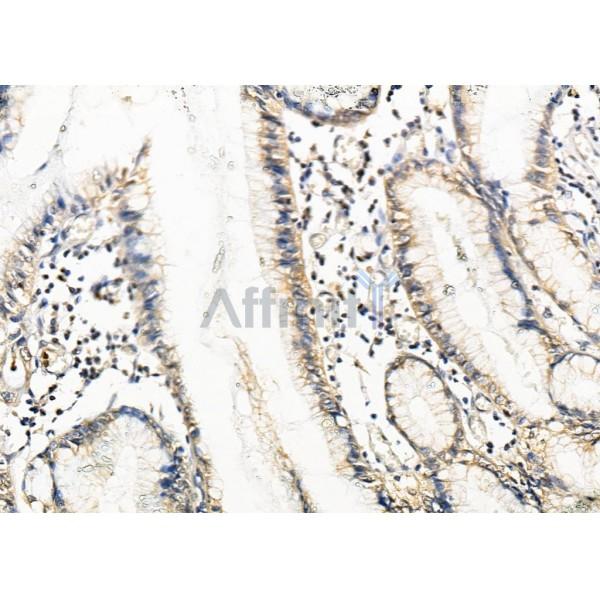 RTKN Antibody - DF9868 at 1/100 staining Human colorectal cancer by IHC-P.