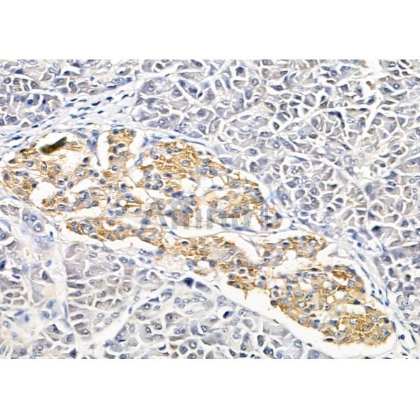 SLC4A7 Antibody - DF9927 at 1/100 staining Human gastric cancer by IHC-P.
