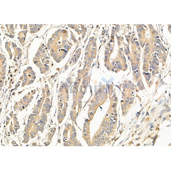 TBC1D2 Antibody - DF9957 at 1/100 staining Human pancreatic cancer by IHC-P.