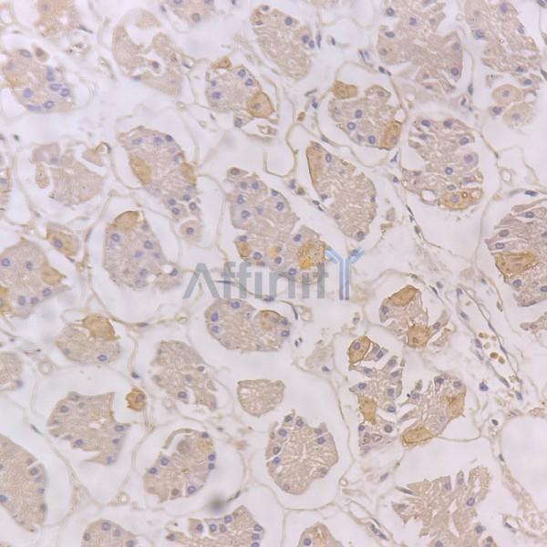 RARRES1 Antibody - DF15454 at 1/100 staining human gastric cancer tissue by IHC-P.