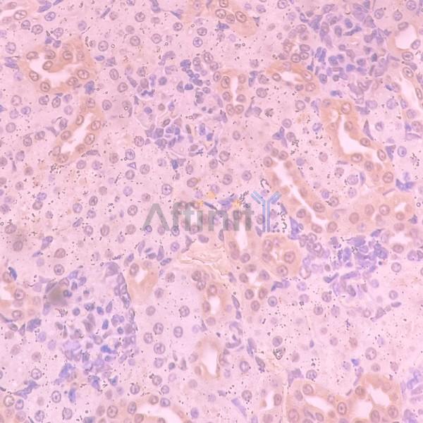 RARRES1 Antibody - DF15454 at 1/100 staining human kidney cancer and para-carcinoma tissue by IHC-P.