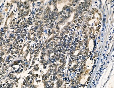 LEG4 Antibody - DF8674 at 1/100 staining human pancreatic cancer by IHC-P.