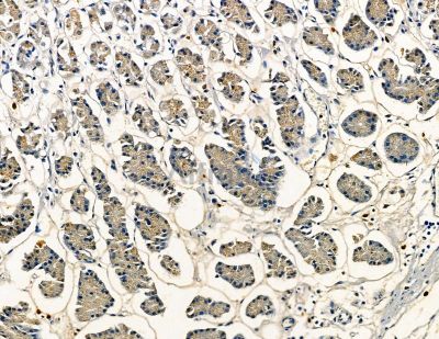 DUSP14 Antibody - DF8767 at 1/100 staining human colorectal cancer and para-carcinoma tissue by IHC-P.