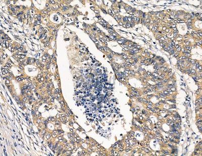 PLXDC2 Antibody - DF8840 at 1/100 staining human liver cancer by IHC-P.