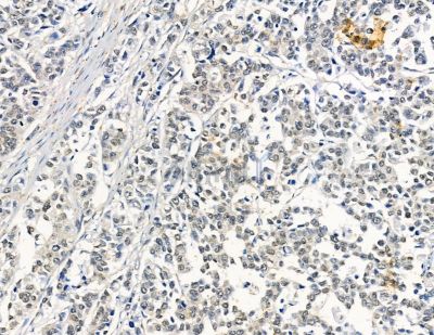 IP6K1 Antibody - DF8856 at 1/100 staining human colorectal cancer by IHC-P.