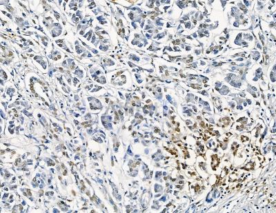 GTF2H4 Antibody - DF8857 at 1/100 staining human gastric cancer by IHC-P.