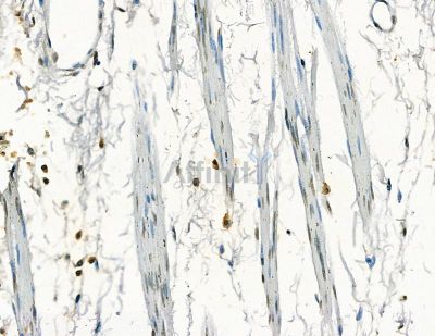 GTF2H4 Antibody - DF8857 at 1/100 staining human esophageal cancer and para-carcinoma tissue by IHC-P.