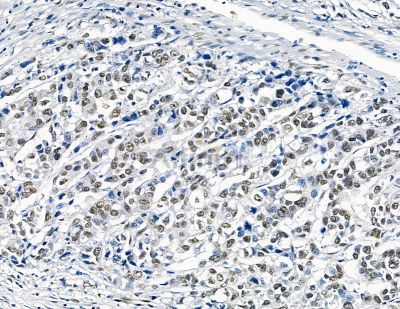 GTF2H4 Antibody - DF8857 at 1/100 staining human colorectal cancer by IHC-P.