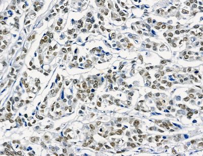 GTF2H4 Antibody - DF8857 at 1/100 staining human colorectal cancer by IHC-P.