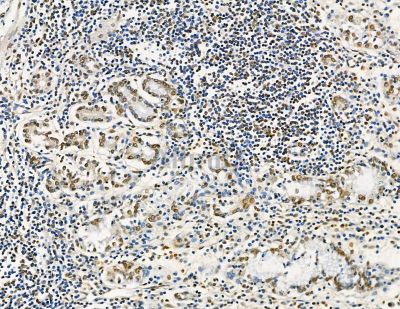 GTF2H4 Antibody - DF8857 at 1/100 staining human pancreatic cancer and para-carcinoma tissue by IHC-P.