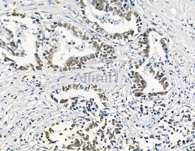 GTF2H4 Antibody - DF8857 at 1/100 staining human pancreatic cancer by IHC-P.