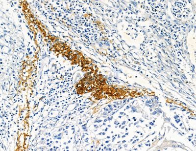 Collagen VIII  alpha 1 Antibody - DF8902 at 1/100 staining human esophageal cancer by IHC-P.