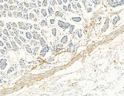 Collagen VIII  alpha 1 Antibody - DF8902 at 1/100 staining human colorectal cancer and para-carcinoma tissue by IHC-P.