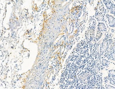 Collagen VIII  alpha 1 Antibody - DF8902 at 1/100 staining human pancreatic cancer and para-carcinoma tissue by IHC-P.