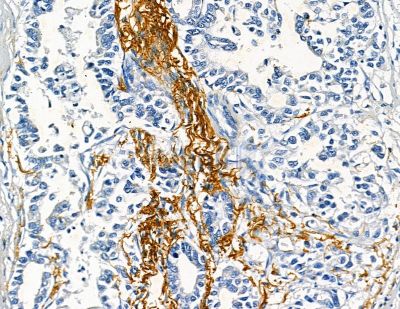 Collagen VIII  alpha 1 Antibody - DF8902 at 1/100 staining human pancreatic cancer by IHC-P.