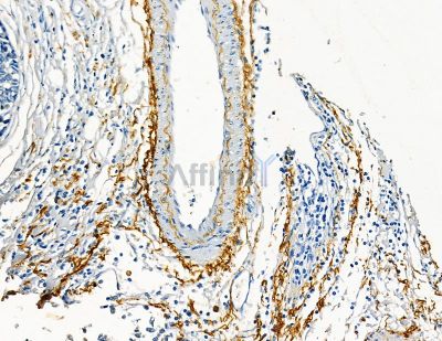 Collagen VIII  alpha 1 Antibody - DF8902 at 1/100 staining human pancreatic cancer by IHC-P.