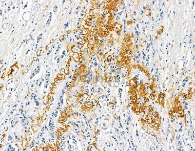 Collagen VIII  alpha 1 Antibody - DF8902 at 1/100 staining human lung cancer by IHC-P.