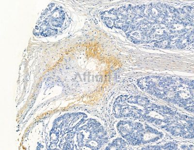 Collagen VIII  alpha 1 Antibody - DF8902 at 1/100 staining human liver cancer by IHC-P.