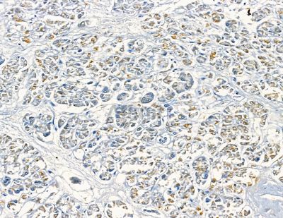CDCA7L Antibody - DF8916 at 1/100 staining human gastric cancer and para-carcinoma tissue by IHC-P.