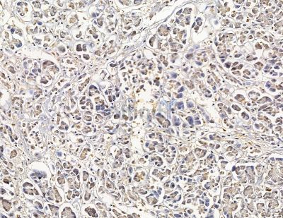 Cytochrome c Oxidase 7B2 Antibody - DF8937 at 1/100 staining human gastric cancer by IHC-P.
