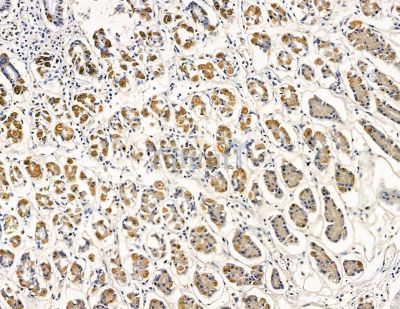 Cytochrome c Oxidase 7B2 Antibody - DF8937 at 1/100 staining human colorectal cancer and para-carcinoma tissue by IHC-P.