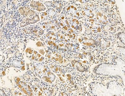 Cytochrome c Oxidase 7B2 Antibody - DF8937 at 1/100 staining human pancreatic cancer and para-carcinoma tissue by IHC-P.