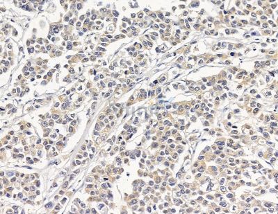 DNAJB5 Antibody - DF8941 at 1/100 staining human colorectal cancer by IHC-P.