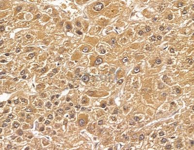 FGFBP3 Antibody - DF8950 at 1/100 staining human mammary cancer and para-carcinoma tissue by IHC-P.