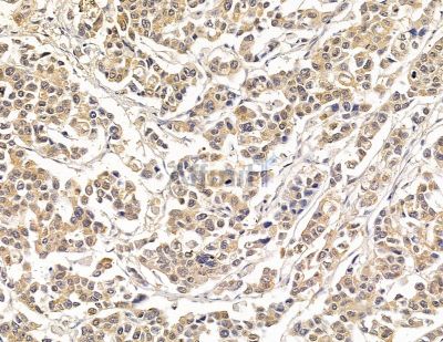 HSBP1 Antibody - DF8954 at 1/100 staining human colorectal cancer by IHC-P.