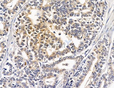 HSBP1 Antibody - DF8954 at 1/100 staining human pancreatic cancer by IHC-P.