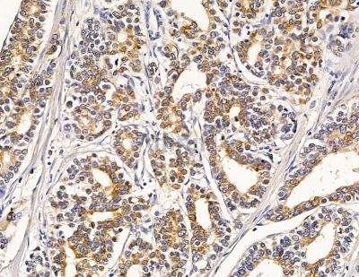 ROBLD3 Antibody - DF9021 at 1/100 staining human pancreatic cancer by IHC-P.