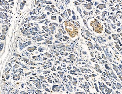 CATSPERB Antibody - DF9352 at 1/100 staining human gastric cancer by IHC-P.