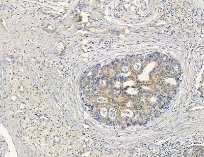 DYNLRB2 Antibody - DF9472 at 1/100 staining human liver cancer by IHC-P.