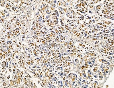 GJB5 Antibody - DF9528 at 1/100 staining human gastric cancer by IHC-P.