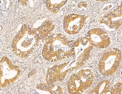 HLA-DQB2 Antibody - DF9574 at 1/100 staining human pancreatic cancer by IHC-P.