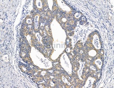 TIGA1 Antibody - DF9793 at 1/100 staining human liver cancer by IHC-P.