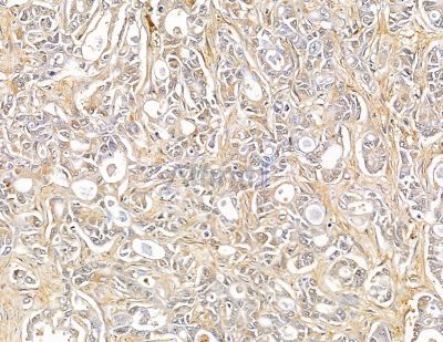SH3PXD2A Antibody - DF9902 at 1/100 staining human mammary cancer by IHC-P.