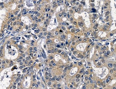 NADAP Antibody - AF0468 at 1/100 staining human liver cancer by IHC-P.