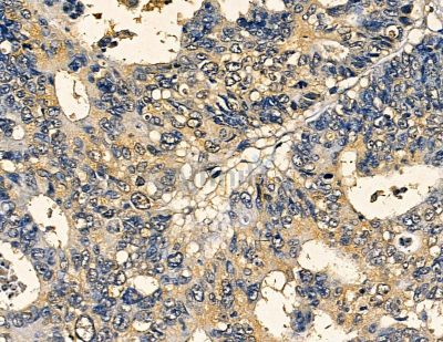 VDAC3 Antibody - DF13768 at 1/100 staining human liver cancer by IHC-P.