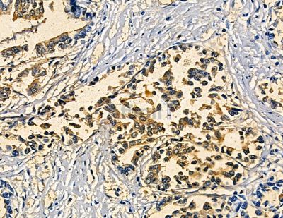 SOX30 Antibody - DF13776 at 1/100 staining human pancreatic cancer and para-carcinoma tissue by IHC-P.