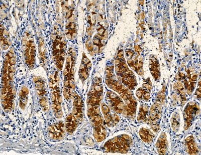 TFB2M Antibody - DF13810 at 1/100 staining human pancreatic cancer and para-carcinoma tissue by IHC-P.